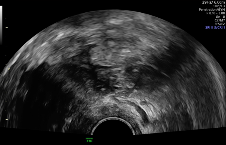 M6.2: Bildbasierte Bewegungsanalyse zur Objektivierung des Sliding Signs in transvaginalen Ultraschallsequenzen